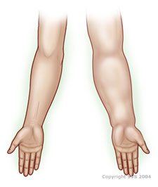 Lymphoedema
